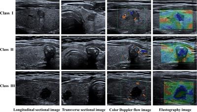 Multi-modal ultrasound multistage classification of PTC cervical lymph node metastasis via DualSwinThyroid